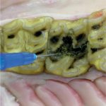 Infundibular Caries treatment injection